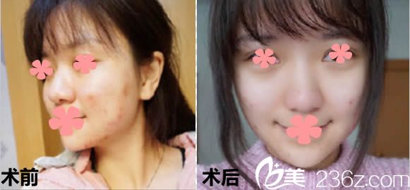 王珊珊祛痘案例及前后对比效果图