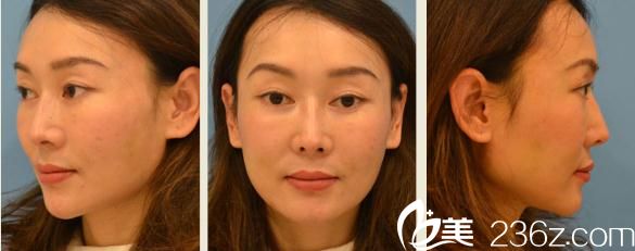 铃木芳郎面部埋线提升后一周 铃木芳郎面部埋线提升后一周