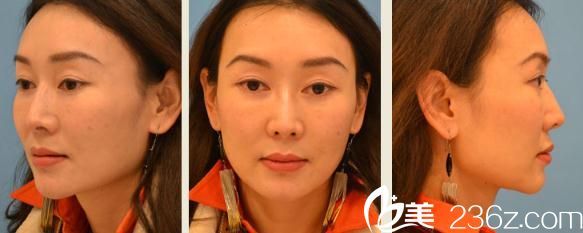 我想感谢他一辈子!Dr.spa医院的铃木芳郎为我做的面部埋线提升真的太棒了!