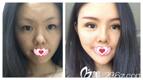 廊坊华康双眼皮案例 廊坊华康双眼皮案例