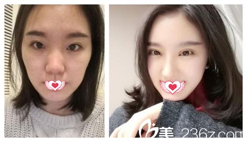 华康整形医院做硅胶隆鼻前后对比 华康整形医院做硅胶隆鼻前后对比