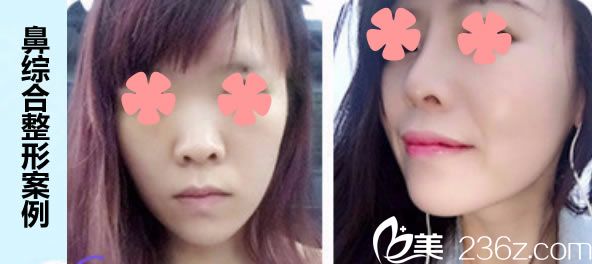 泉州欧菲胡利韬鼻综合隆鼻一年后对比效果