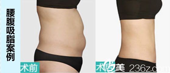 泉州欧菲韩飞腰腹吸脂案例及前后对比效果