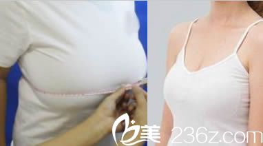 韩国一美知整形巨乳缩小美化术案例效果对比图