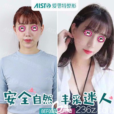 在找孙院长做丰胸效果图 在找孙院长做丰胸效果图