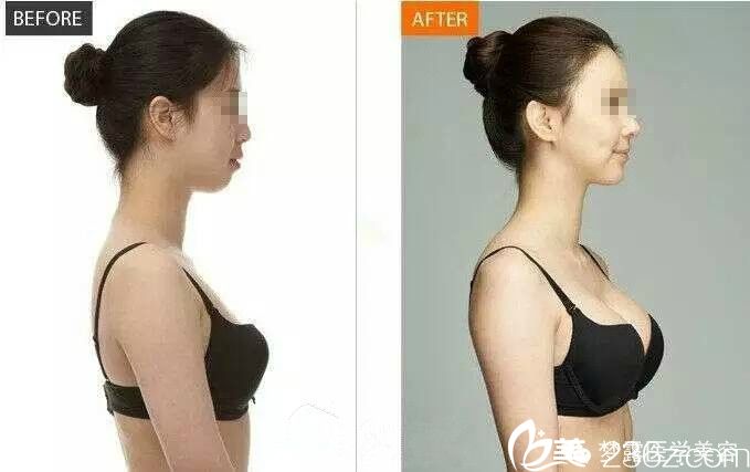 佛山梦露游万福院长隆胸前后对比图 佛山梦露游万福院长隆胸前后对比图