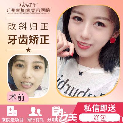 广州壹加壹隐形牙齿矫正实例 广州壹加壹隐形牙齿矫正实例