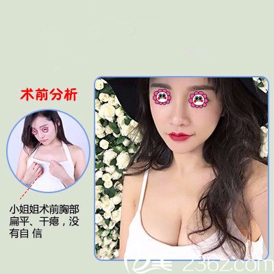 郑州医德佳整形医院丰胸效果图