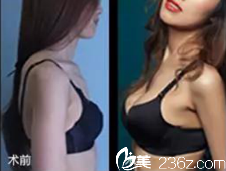 假体丰胸术前术后对比照片 假体丰胸术前术后对比照片