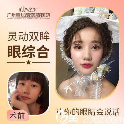 广州壹加壹双眼皮实例 广州壹加壹双眼皮实例
