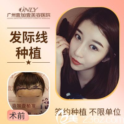广州壹加壹发际线种植实例 广州壹加壹发际线种植实例