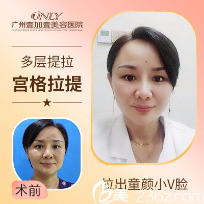 广州壹加壹埋线提升宫格拉提真人实例 广州壹加壹埋线提升宫格拉提真人实例