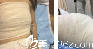 胸部修复术前照片 胸部修复术前照片