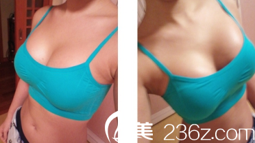 修复完成之后胸部的状态 修复完成之后胸部的状态