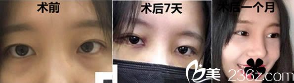 石狮栢丽内切祛眼袋案例及恢复过程图 石狮栢丽内切祛眼袋案例及恢复过程图