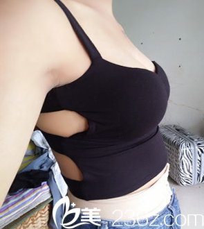 我找太原欧美莲张世民做自体脂肪隆胸术后第3天照片 我找太原欧美莲张世民做自体脂肪隆胸术后第3天照片