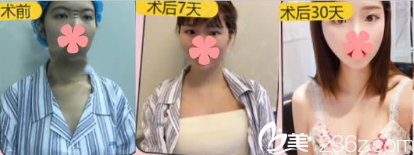 石狮栢丽曼托假体隆胸前后对比案例 石狮栢丽曼托假体隆胸前后对比案例