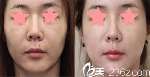 瑞姿整形医院面部提升案例对比图 瑞姿整形医院面部提升案例对比图
