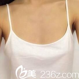 自体脂肪丰胸术前 自体脂肪丰胸术前