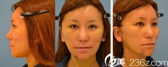 铃木芳郎面部大拉皮手术经过了一周 铃木芳郎面部大拉皮手术经过了一周