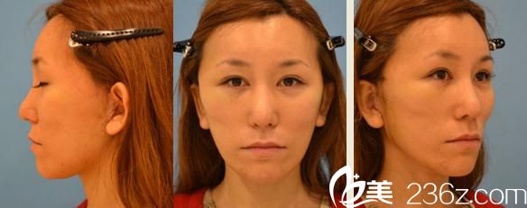 铃木芳郎面部大拉皮手术经过了两周后 铃木芳郎面部大拉皮手术经过了两周后