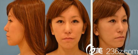 铃木芳郎面部大拉皮手术过去一个月 铃木芳郎面部大拉皮手术过去一个月