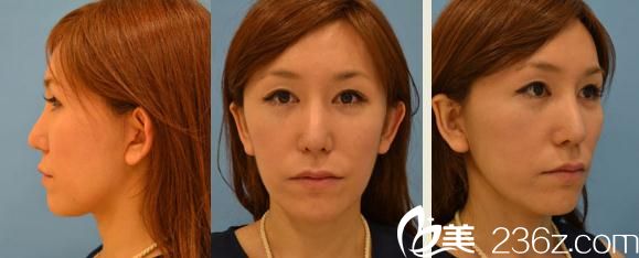 ​面诊了Dr.spa医院的铃木芳郎医生，他做的面部大拉皮手术从此让我笑靥动人!