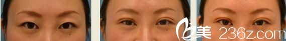 Dr.Sa式的埋线双眼皮前及3日、5日后的照片 Dr.Sa式的埋线双眼皮前及3日、5日后的照片