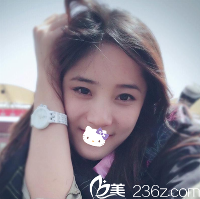 隆鼻前的塌鼻子照片