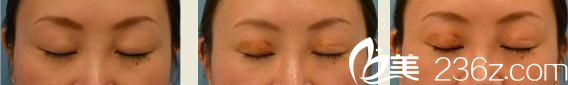 Dr.spa医院-铃木芳郎医生的埋线技术到底怎么样?看我的埋线双眼皮前后对比效果