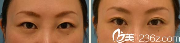 Dr.Sa式的埋线双眼皮前后对比 Dr.Sa式的埋线双眼皮前后对比