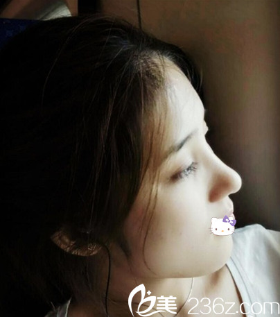 绵阳朗睿刘锋假体+耳软骨综合隆鼻术后侧面照