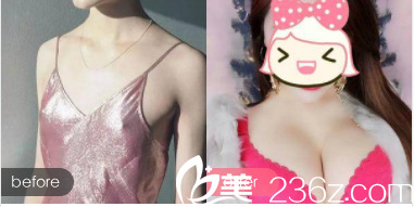 北京亚馨美莱坞假体隆胸案例