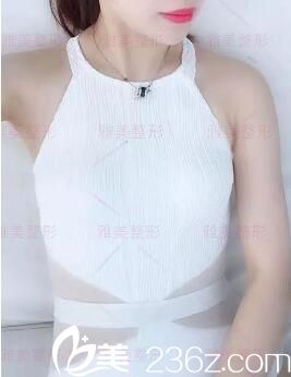 做娜绮丽假体隆胸术前照 做娜绮丽假体隆胸术前照