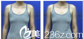 因价格优惠我在北京亚馨美莱坞医院找李辉做自体脂肪隆胸来看2个月效果