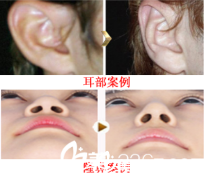 六安伊而美耳部整形案例及隆鼻案例前后对比图