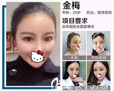 自体脂肪全面部填充恢复过程