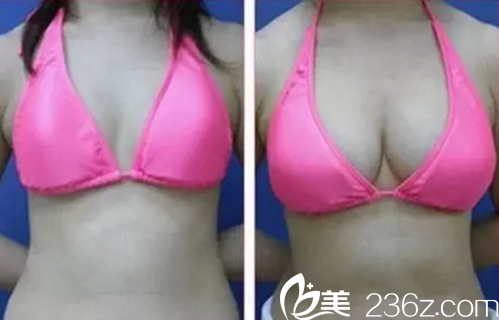 曹家整形隆胸前后对比 曹家整形隆胸前后对比