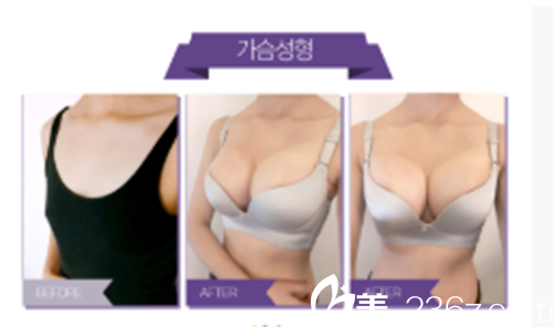 韩国WESHE整形外科医院胸部整形