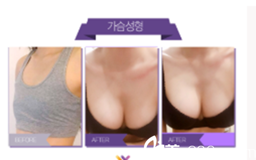 韩国WESHE整形外科医院胸部整形