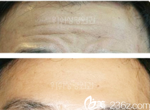 韩国WESHE整形外科医院除皱