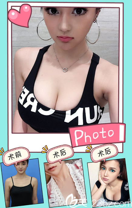 佛山美莱孙婧隆胸案例 佛山美莱孙婧隆胸案例