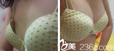 <!--<i data=20240703-sp></i>-->美莱整形动感假体隆胸效果对比图