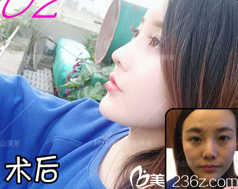 佛山美莱王燕隆鼻案例 佛山美莱王燕隆鼻案例