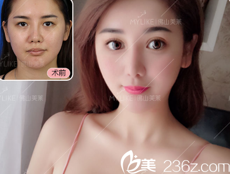 佛山美莱刘永扬双眼皮案例对比图 佛山美莱刘永扬双眼皮案例对比图