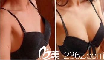 北京美莱整形才杰假体隆胸案例前后对比图 北京美莱整形才杰假体隆胸案例前后对比图