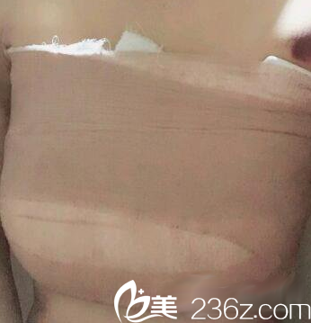 山西整形外科医院刘晋元给我做自体脂肪隆胸术后第3天照片