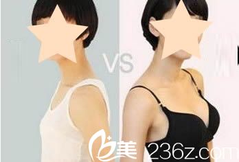 武汉美立方整形胡江伟院长自体脂肪隆胸效果图