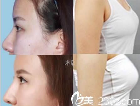 东莞缔美整形赵可医师假体隆鼻和假体隆胸效果图
