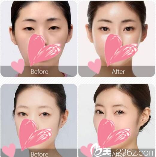 2018圣诞+2019元旦一起相约无锡施尔美 无痕双眼皮水动力吸脂回馈价都只要880元